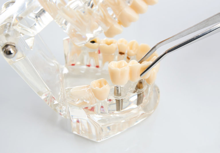 Cedar Smiles Cosmetic & Family Dentistry - Implant Dentistry service