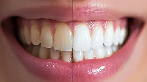 In Office Bleaching