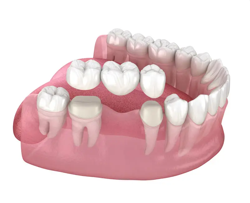 Dental Bridges