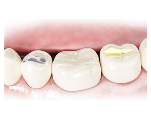 Dental Fillings