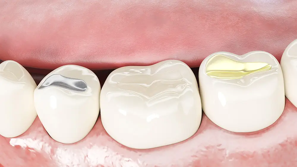 Dental Fillings