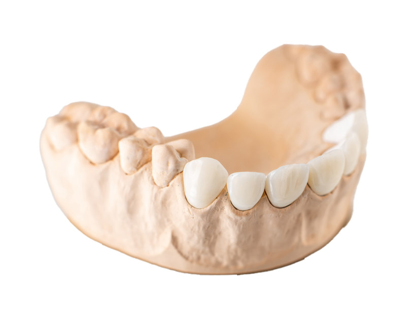 veneer